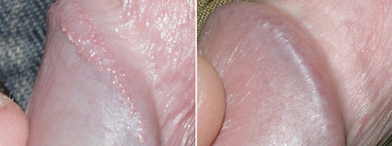 Pearly Penile Papules - before and after removal