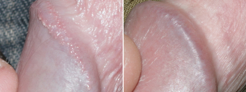 Surgical Excision: In this pearly penile papules treatment the lesions are ...