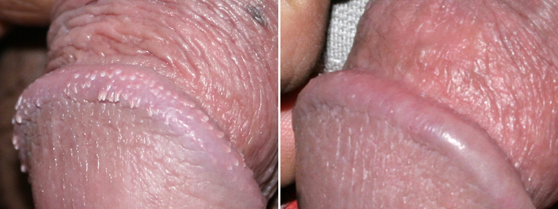 Penis Removal Before And After