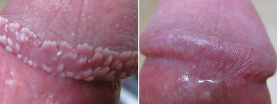 Pearly Penile Papules - before and after removal