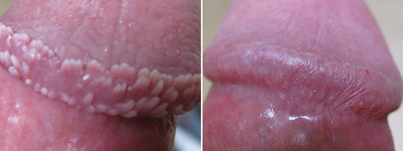 Treatment penile cream papules What Are